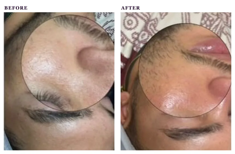 Before and after photos of a men's facial treatment