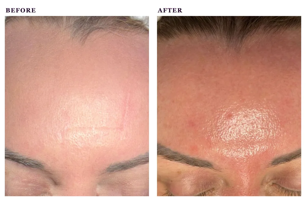 Before and after photos of a hydrating facial treatment
