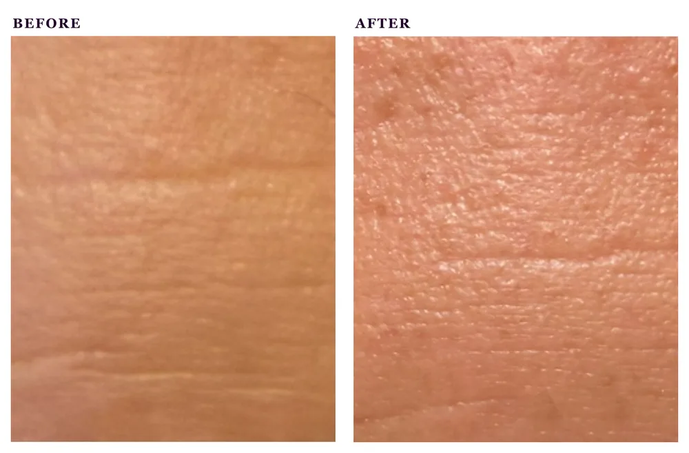Before and after photos of a radiofrequency facial treatment
